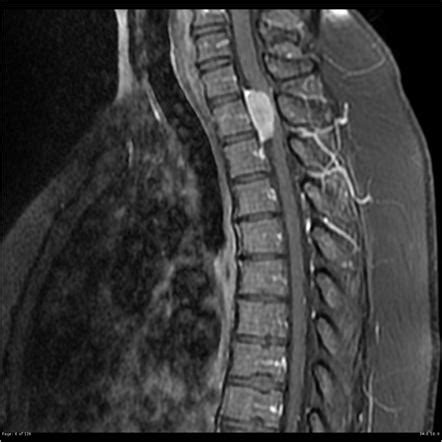 Spinal meningioma | Radiology Reference Article | Radiopaedia.org