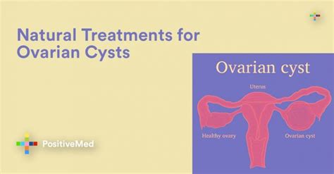 Natural Treatments for Ovarian Cysts