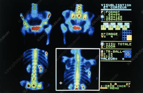 Gamma camera scans of person suffering bone cancer - Stock Image - M134 ...