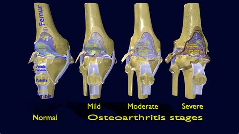 knee osteoarthritis stages - Buy Royalty Free 3D model by Deepankar ...