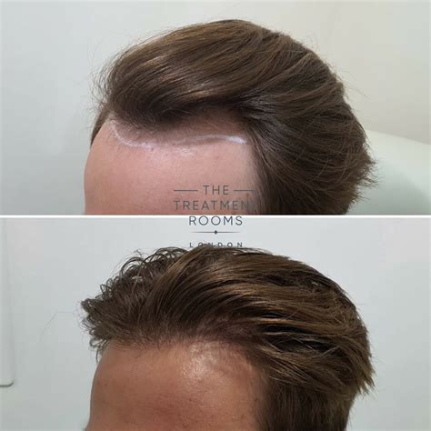 Receding Hairline & Hairline Transplant | Treatment Rooms London