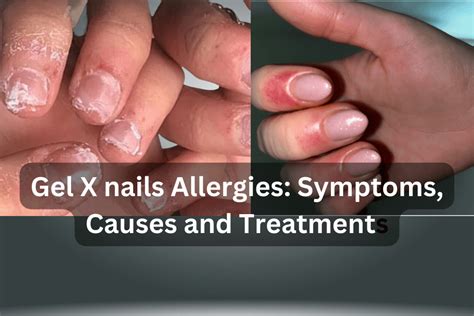 Gel X nails Allergies: Symptoms treatment and prevention - Ultra Beautify