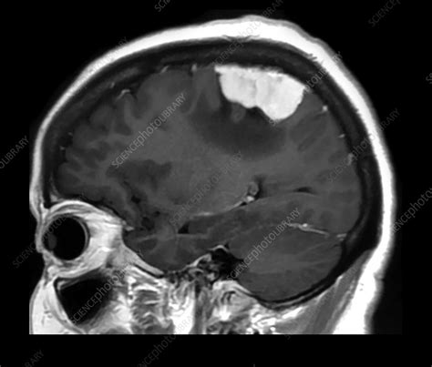 Meningioma, MRI - Stock Image - C058/4476 - Science Photo Library