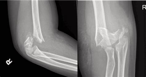 Right Distal Humerus Fracture