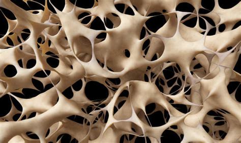 Brittle bone disease: Young adults could soon be screened DECADES ...