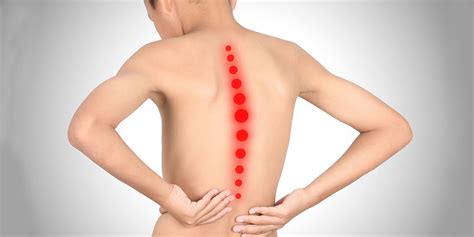 Scheuermann’s Kyphosis Symptoms & Treatments - BSSNY