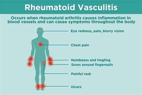 What Is Rheumatoid Vasculitis? Symptoms, Diagnosis, and Treatment