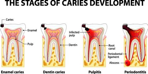 Dental Caries (Tooth Decay)