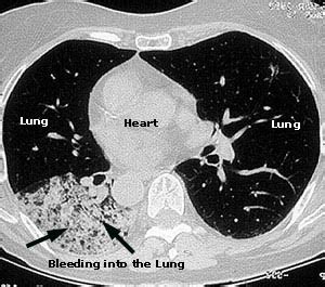 Symptoms of Vasculitis : Johns Hopkins Vasculitis Center