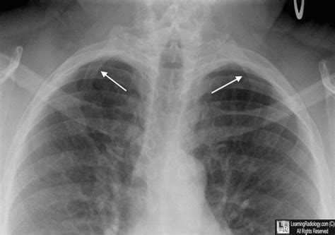 Cervical Rib Complications