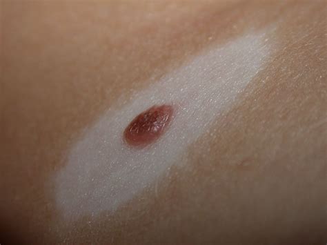 Halo Nevus Mole: Symptoms, Causes, Photos, More