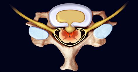 Herniated Disc In Cervical - Dr. Kevin Pauza, The Discseel® Procedure ...