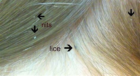 How to Check For Head Lice | Fresh Heads Lice Removal