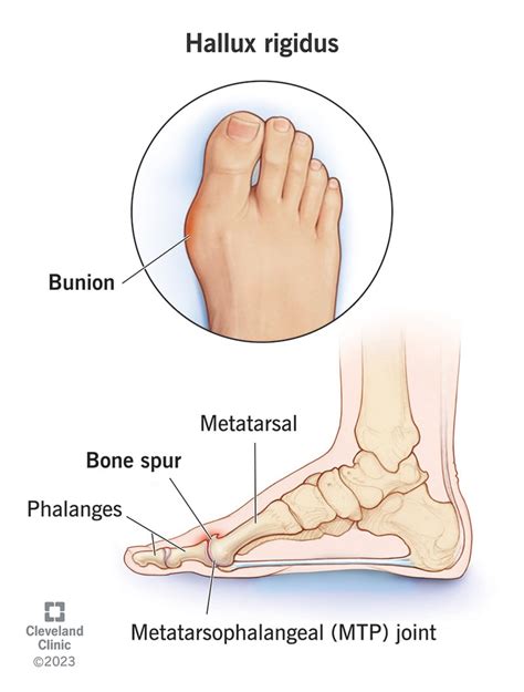 Hallux Rigidus: Symptoms, Causes & Treatment