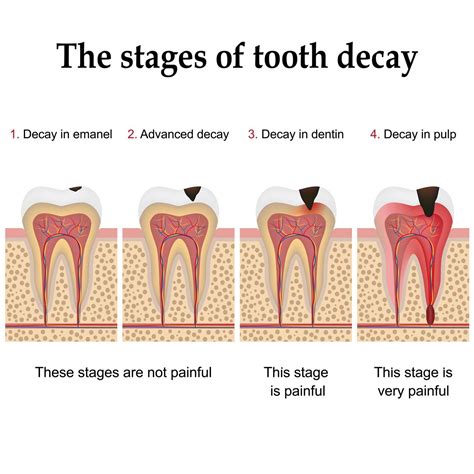 Stages of Tooth Decay | Cedar Creek Dental