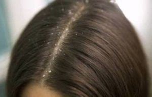 Dandruff and Demodex Mites | Ungex | Demodex Treatment