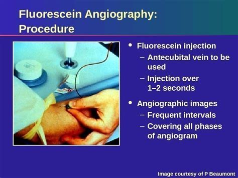 Identifying Choroidal Neovascularization Using Fluorescein Angiography ...