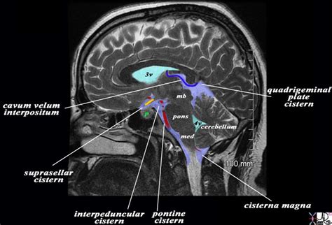 Basal Cisterns Anatomy