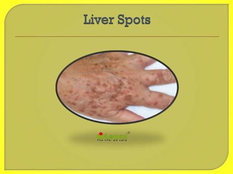 PPT - Liver Spots : Causes, Symptoms, Daignosis, Prevention and ...