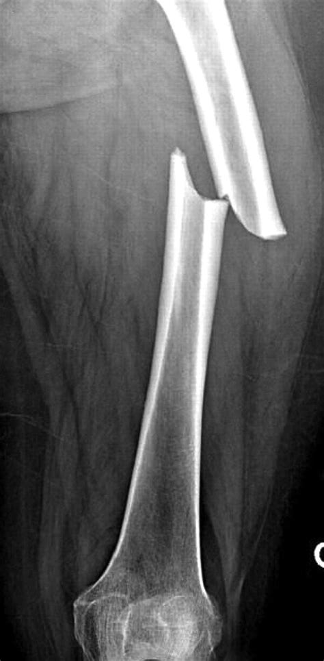 Broken Femur Xray