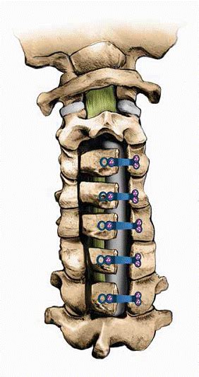 Cervical Laminoplasty Torg Pavlov