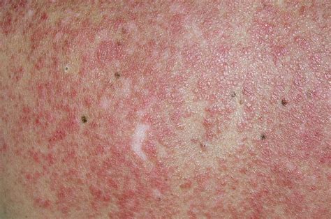 Lupus Rash On Back Triggered By Sun Photograph by Dr P. Marazzi/science ...