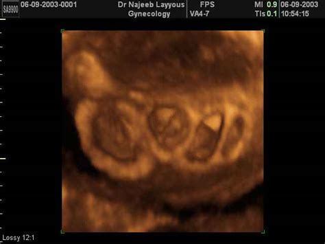 3D Ultrasound Scan photos of Multiple Pregnancy twins triplets ...