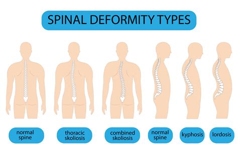 Spine deformity vector illustration. Kyphosis, lordosis spine ...