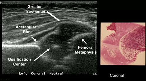 Imaging in developmental hip dysplasia - YouTube