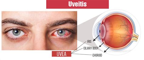 Uveitis | Eye Inflammation - Causes, Symptoms, Complications, Diagnosis ...