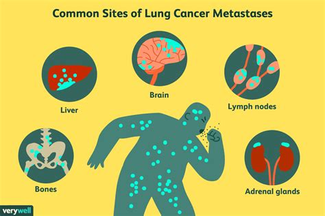 Causes And Symptoms Of Metastatic Bone Cancer