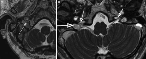 of the Jugular Foramen | Radiology Key