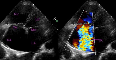 Rheumatic tricuspid regurgitation – All About Cardiovascular System and ...