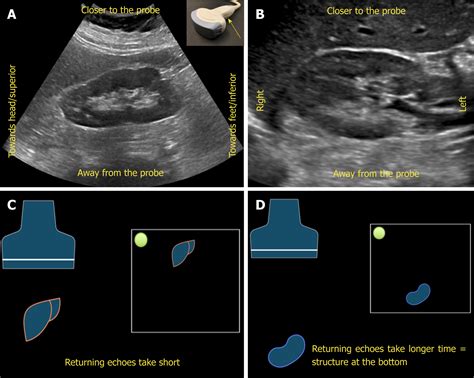 Damaged Kidney Ultrasound