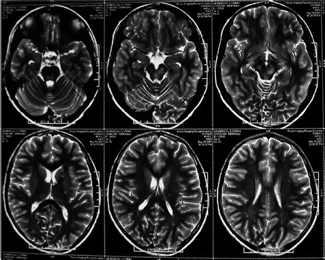 MRI brain showing T1 hypointense and T2/FLAIR hyperintense lesions in ...