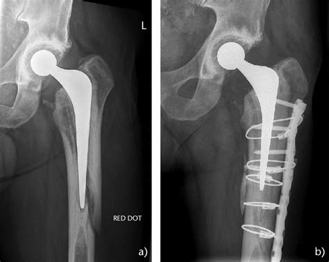 (a) Type B2 periprosthetic femoral fracture around cemented polished ...