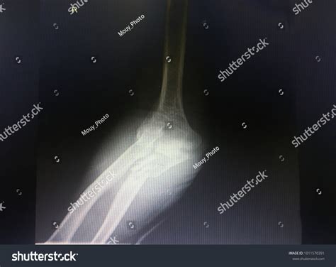 Xray Right Arm Show Bone Fracture Stock Photo 1011570391 | Shutterstock