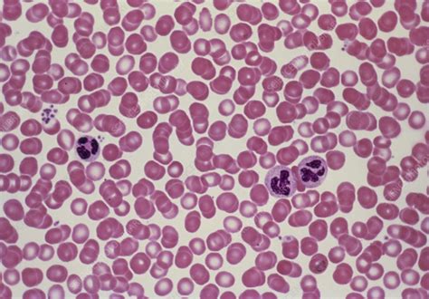 LM of human red blood cells & neutrophils - Stock Image - P242/0107 ...