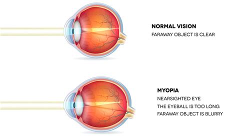 A Comprehensive Guide to Myopia (Short-Sightedness) | Laser Eye Surgery Hub