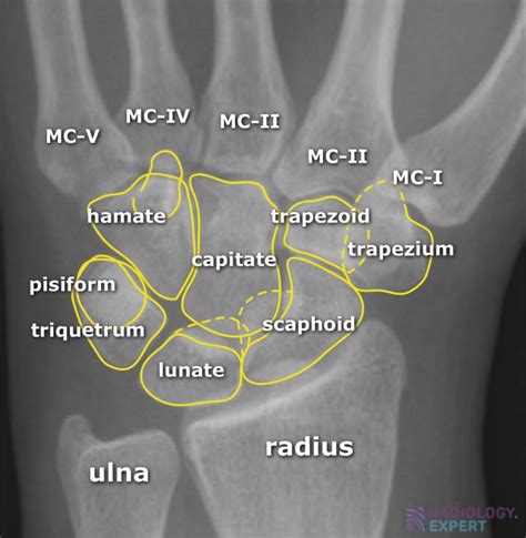 Carpal Bone X Ray