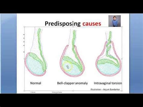 Surgery Torsion testis Bell Clapper deformity Deming Prehn Angeli sign ...