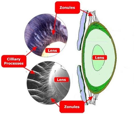 섬모체 소대(수정체 소대) 약화(Zonular weakness)와 섬모체 소대 해리(Zonular Dialysis ...