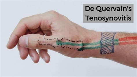 De Quervain's Tenosynovitis (2) - Orthopaedic Spine Surgery Singapore