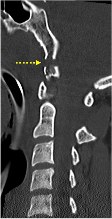 Para-sagittal CT shows “en piece” fracture of the clivus (yellow dotted ...