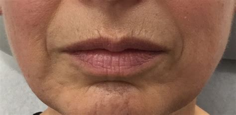 Juvederm Lips Before And After 1/2 Syringe / Lips : The results can ...