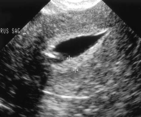 Sonohysterography: The Next Step in the Evaluation of the Abnormal ...