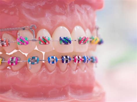 Types of Braces and Appliances — Marysville Orthodontics | Braces ...