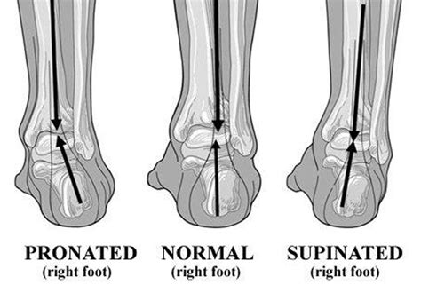 The Effects of Hyperpronation – Propet USA Blog