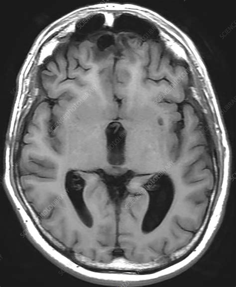 Chronic Post-Traumatic Brain Injury, MRI - Stock Image - C030/6067 ...