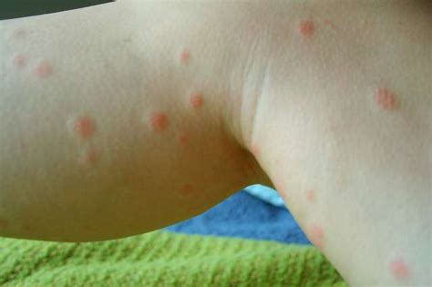 What are Chiggers - Rural Messenger